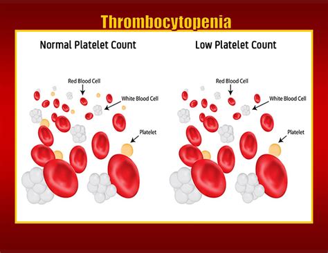 Thrombocytopenia Levels