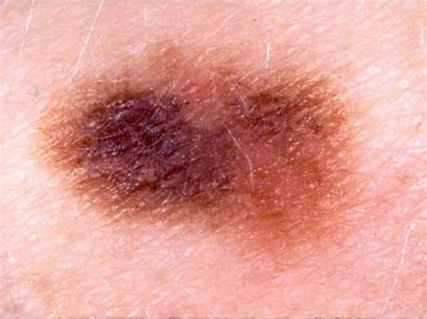 Skin Cancer Or Mole How To Tell Photo 1 Cbs News