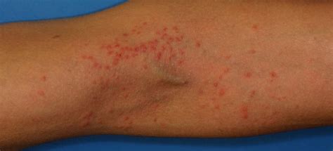 Philadelphia Eczema Atopic Dermatitis Treatment Main Line Eczema