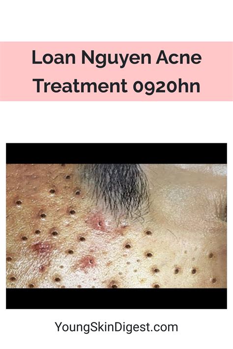 Loan Nguyen Acne Treatment 0920hn Young Skin Digest