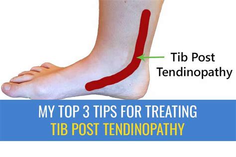 Posterior Tibial Tendon Tear Treatment Sexiz Pix