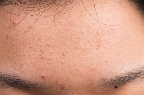 What Is A Blackhead And What Cause Blackheads And How To Get Rid Smile Delivery Online