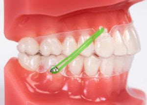 Clear Aligner And Class II Cross Elastics Affinity Dental Care Burlington