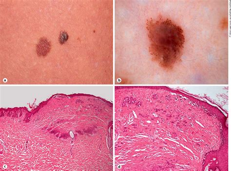 Sclerosing Nevus With Pseudomelanomatous Features Nevus With