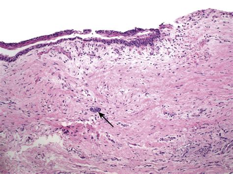 Head And Neck Pathology Ento Key