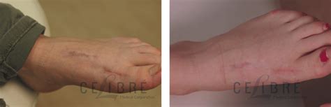 Laser tattoo removal is regarded to be the most effective way to remove tattoos. Carinn; carerynn | Malaysia Fashion, Beauty & Lifestyle ...