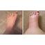 Are Your Ankles And Feet Swollen Then You May Have Ankle Oedema 