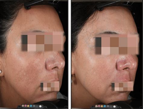 Melasma A Before Treatment And B After Treatment With Topical 3