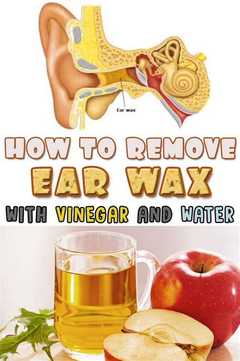 Aahow To Remove Ear Wax With Vinegar And Water Ear Wax Impacted Ear