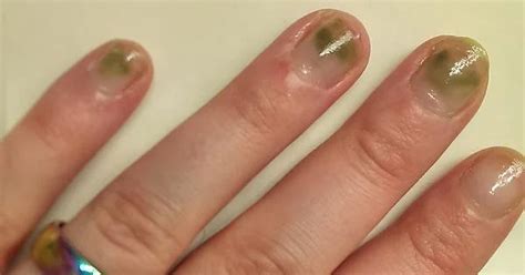 Green Fungus Under Acrylic Nails Causes And Treatments