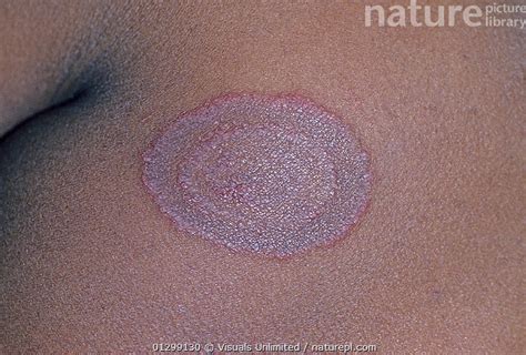Images Of Ringworm On Human Skin Naturalskins