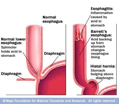 Barretts Esophagus - Digestive Healthcare Center