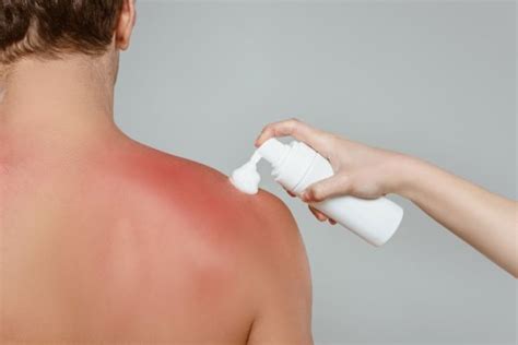 A Complete Guide For Detection And Treatment Of Sun Poisoning