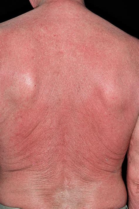 Rash On Back After Cancer Treatment Photograph By Dr P Marazzi Science My Xxx Hot Girl