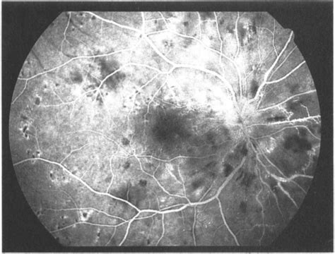 Fundus Photograph A And Fluorescein Angiograms B C Of A