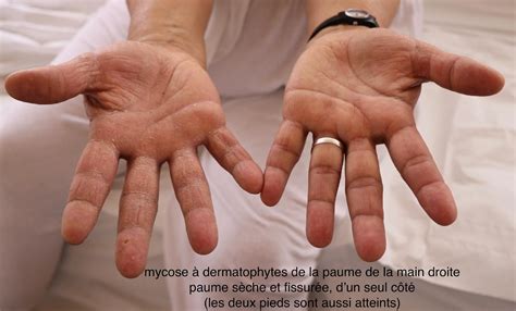 Dermato Info Les Mycoses Cutanées
