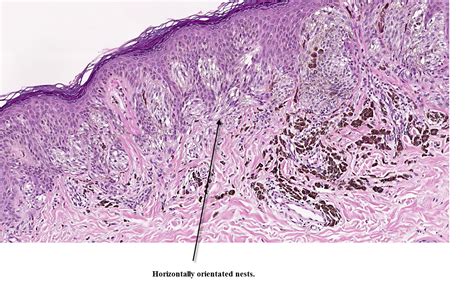 Dermpath Made Simple Neoplastic Spitz Nevus And Reed Nevus