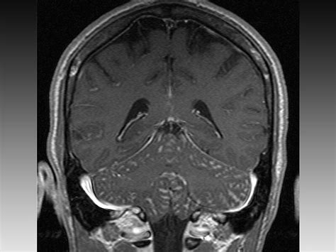 A Negative Trial For Cryptococcal Meningitis