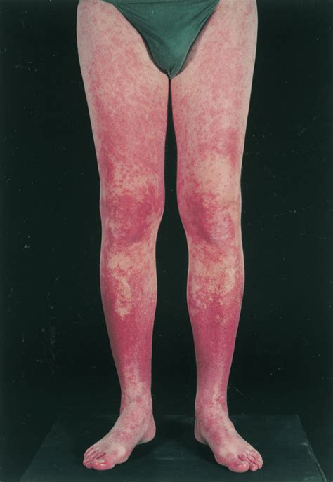 Carbamazepine Induced Vasculitic Rash On The Lower Legs The Rash On