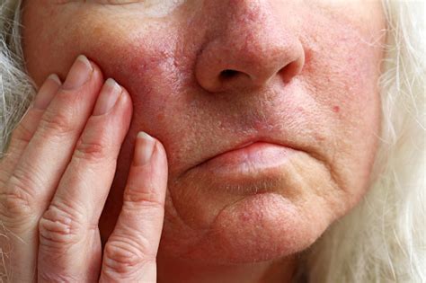 Red Veins Spots And Operation Scars On The Face Of An Older Woman Stock