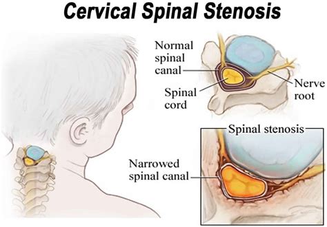 Neural Foraminal Stenosis Causes Symptoms Diagnosis Treatment