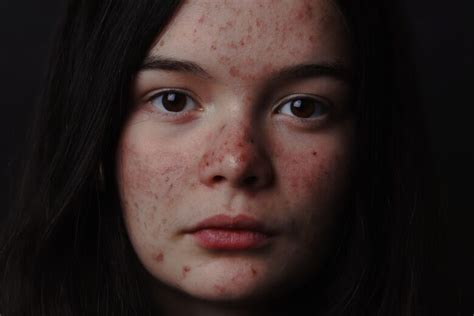 Understanding Adult Acne Why Acne Scars Are More Than Skin Deep