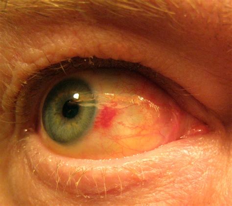 Subconjunctival Hemorrhage Blood In Eye Youtube