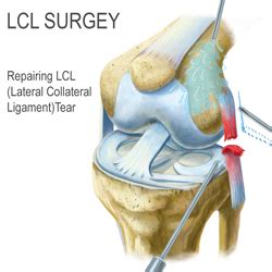 Ligament injuries generally result in pain and instability with a moderate (grade 2) sprain, the ligament tears partially. LCL Tear Surgery