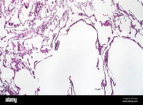 Histopathology Of Lung Emphysema Light Micrograph Photo Under