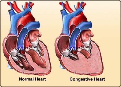 Many people tend to think that heart failure means that the entire heart has stopped working, however this is not true. Congestive Heart Failure (CHF). Causes, symptoms ...
