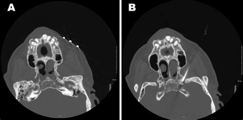 Axial Noncontrast Ct Scans Showing Localization Of The Foramen Ovale