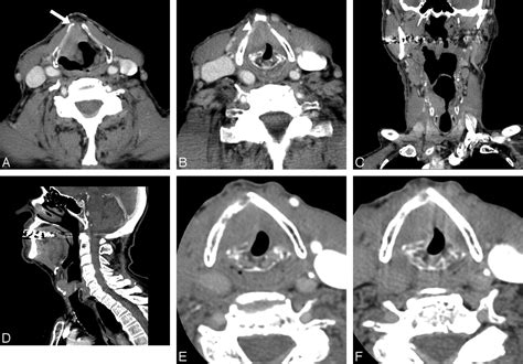 Staging Of Laryngeal Cancer Using 64 Channel Multidetector Row Ct