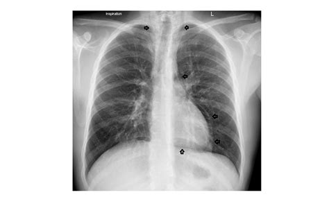 Imaging Case Of The Week 152 Answer Emergucate