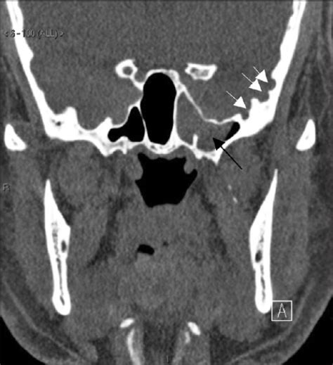 Coronal Reformatted Ct Scan Demonstrates Arachnoid Pits Open I