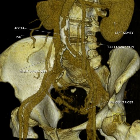 They have me on prednisone, and methotrexate. Pelvic varicosities | Image | Radiopaedia.org