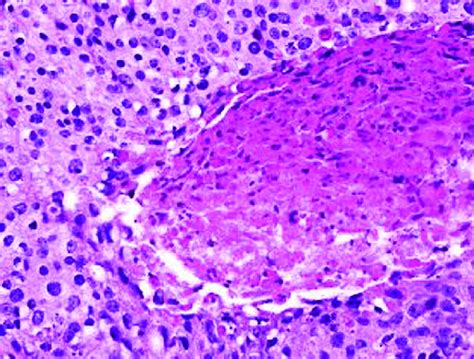 Basaloid Carcinoma Homogeneous Basaloid Cells With Rounded Nuclei