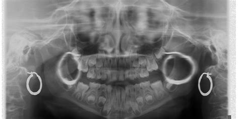 Why Remove Jewellery For A Cbct Scan Royal Dental Clinics Blog