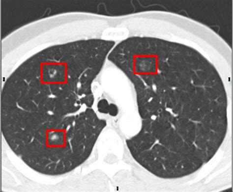 Lung Cancer Chest Ct Scan With Contrast