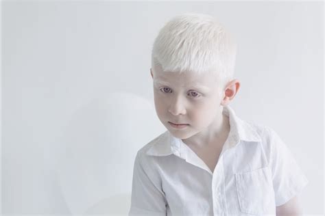 Albinism Photographs Yulia Taits POPSUGAR Beauty Photo
