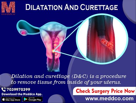 D And C Dilation And Curettage