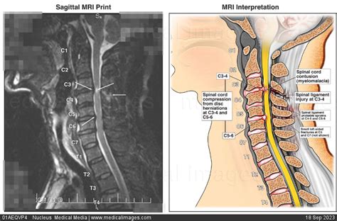 Stock Image Mri And Illustration Side Views Of Injuries To Neck At