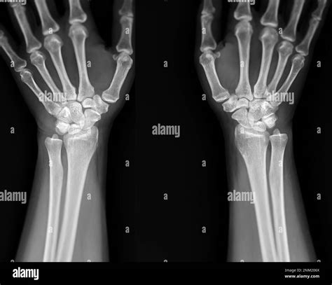 X Ray Image Of Wrist Joint Front View Of Normal Wrist Joint Stock Photo