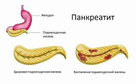 Лечение поджелудочной железы диеты Фиброз и липофиброз поджелудочной железы: что это такое, каковы причины Фиброз и липофиброз поджелудочной железы: что это такое, каковы причины Лечение поджелудочной железы диеты