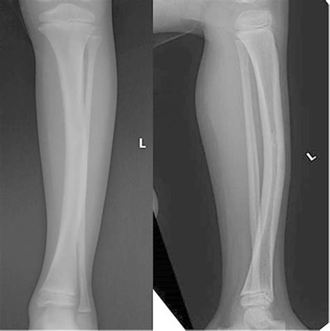 Whats New In Limb Lengthening And Deformity Correction 2021 Orthobuzz