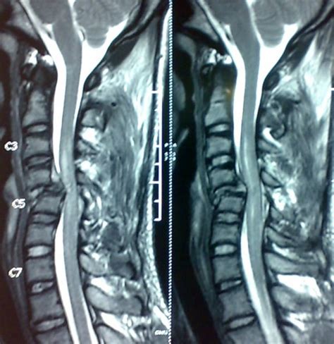Cervical Injury Xrays Bone And Spine