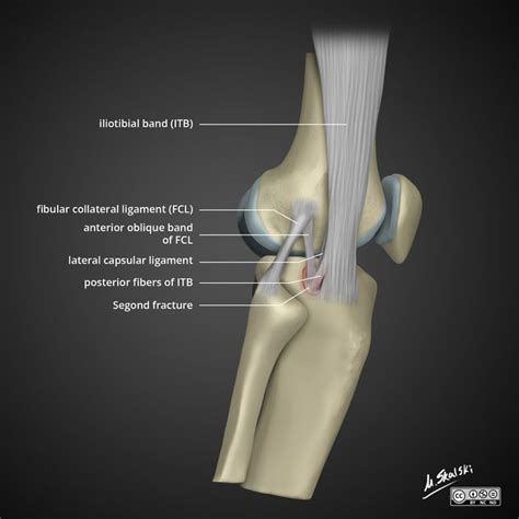 Segond Fracture Radiology Reference Article