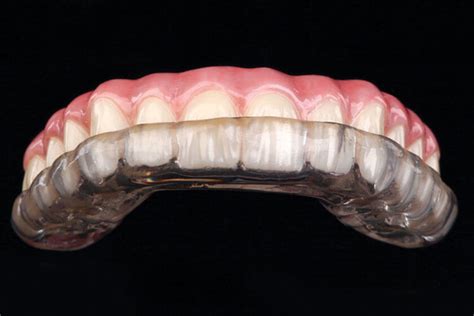 Custom Fit Vs Store Bought Occlusal Guard