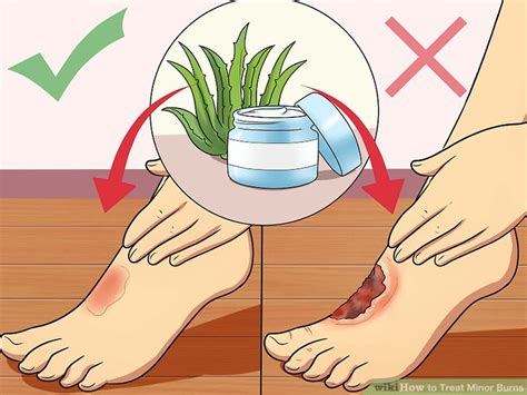 How To Treat Minor Burns 11 Steps With Pictures Wikihow