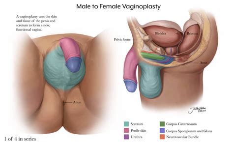 Second Type Woman Surgical Options For The Transsexual Woman