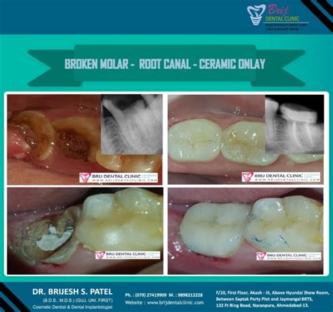 Tooth Filling Cost In Ahmedabad Dental Cavity Treatment In Ahmedabad